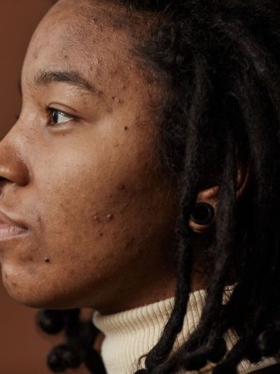 Clear Skin Reset – For Acne & Breakouts