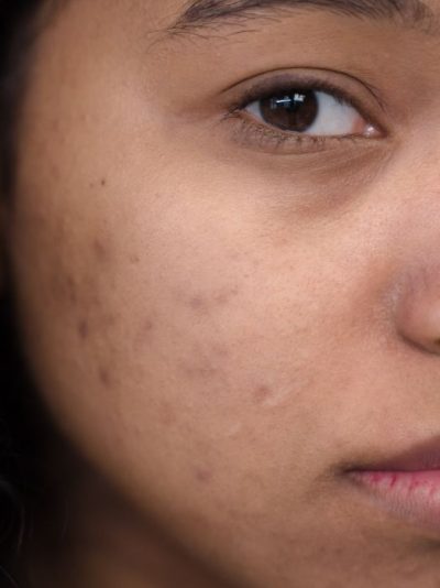 Even Tone & Glow – For Dark Spots & Hyperpigmentation