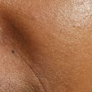 Skin Renewal – For Wrinkles & Fine Lines