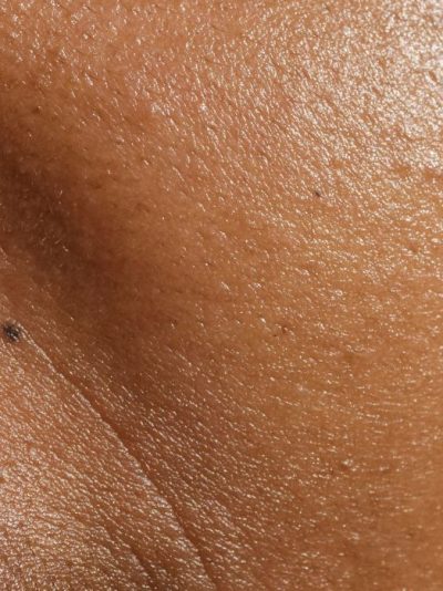 Skin Renewal – For Wrinkles & Fine Lines